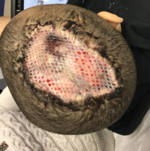 Skin graft to the top of a boy's head following a canine attack that removed skin