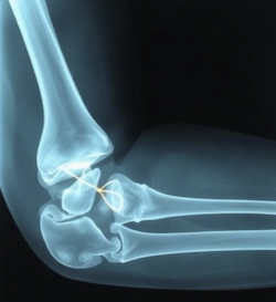 A radiograph (x-ray) of a broken bone